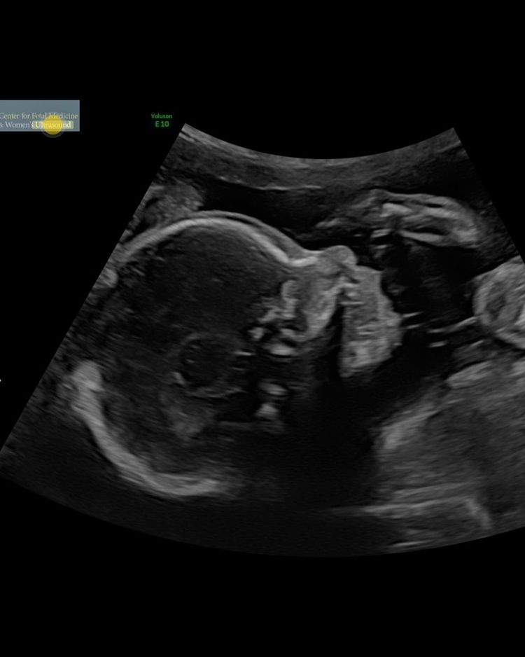 Sonogram of Josephine Skriver's baby
